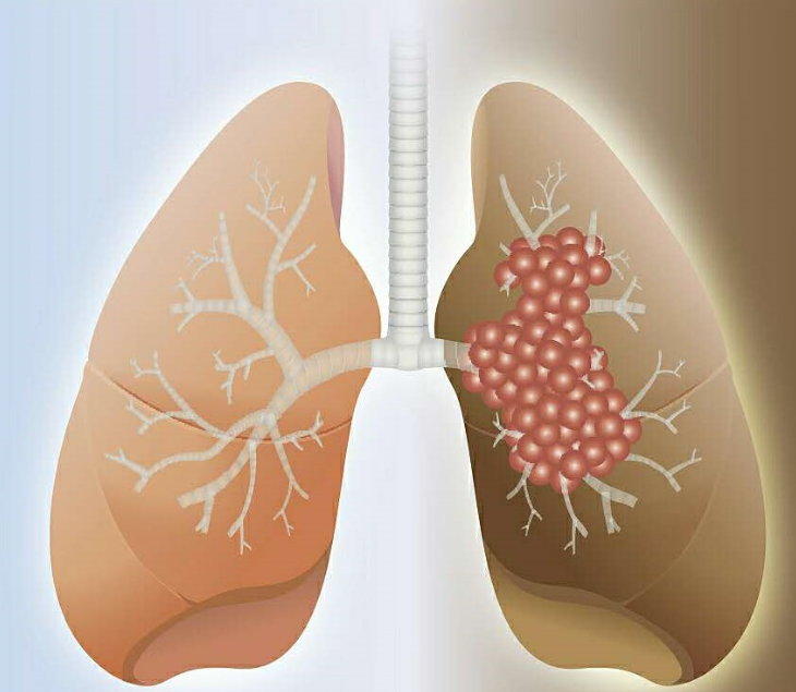 肺癌早期疼痛信號
