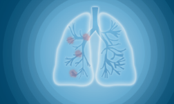肺癌局部擴散后的癥狀與體征全解析