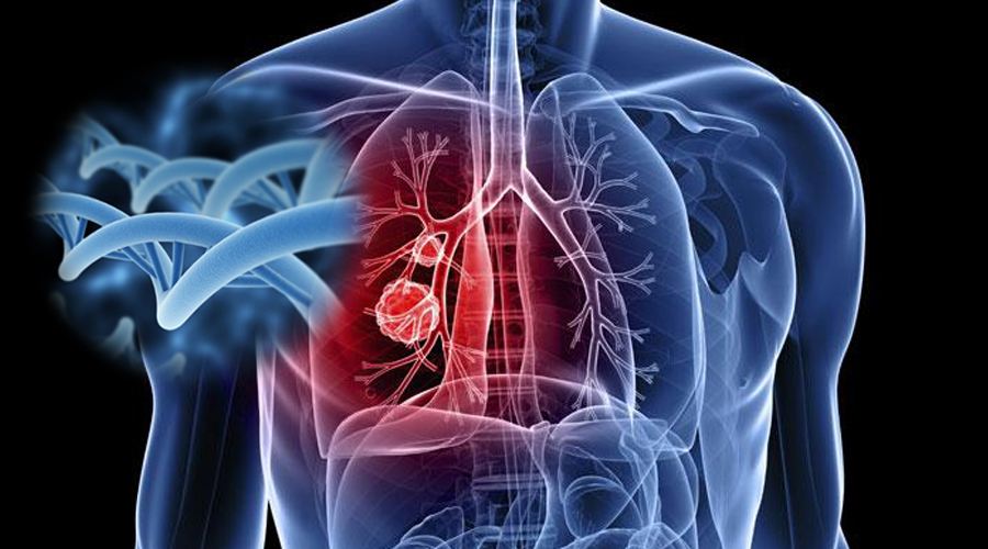 肺癌預防措施有哪些