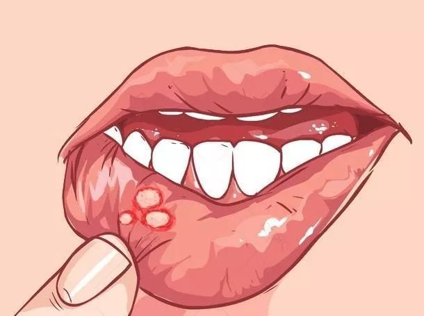 全面解析舌癌淋巴轉移及其治療方案