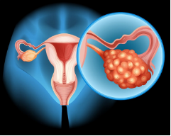 卵巢癌是否會導致卵巢早衰